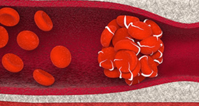 Blood Clot Blood clot